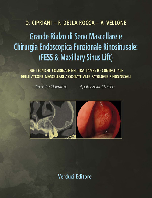 Grande rialzo di seno mascellare e chirurgia endoscopica funzionale rinosinusale. Due tecniche combinate nel trattamento contestuale delle atrofie mascellari associate alle patologie rinosinusali