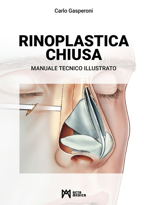 Rinoplastica chiusa. Manuale tecnico illustrato