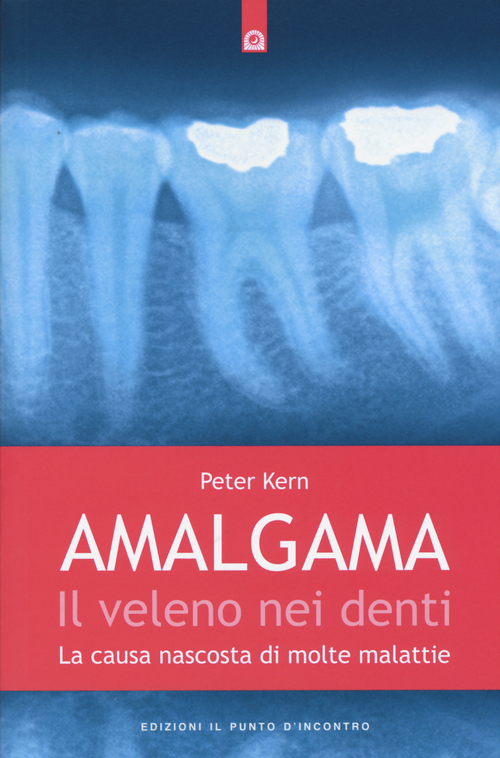 Amalgama. Il veleno nei denti. La causa nascosta di molte malattie